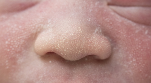 Macro, close-up shot of the milia on a two day old baby cheek, nose and forehead.