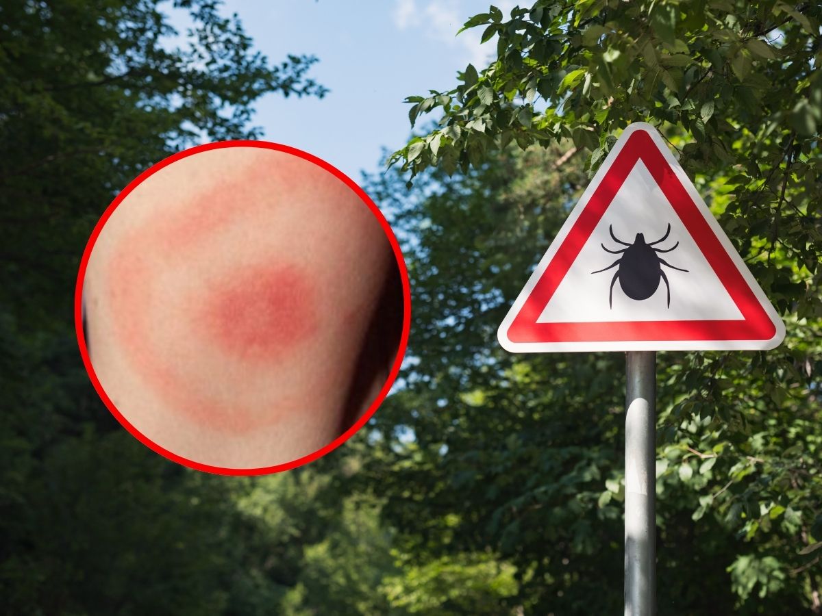 rumień po kleszczu u dziecka