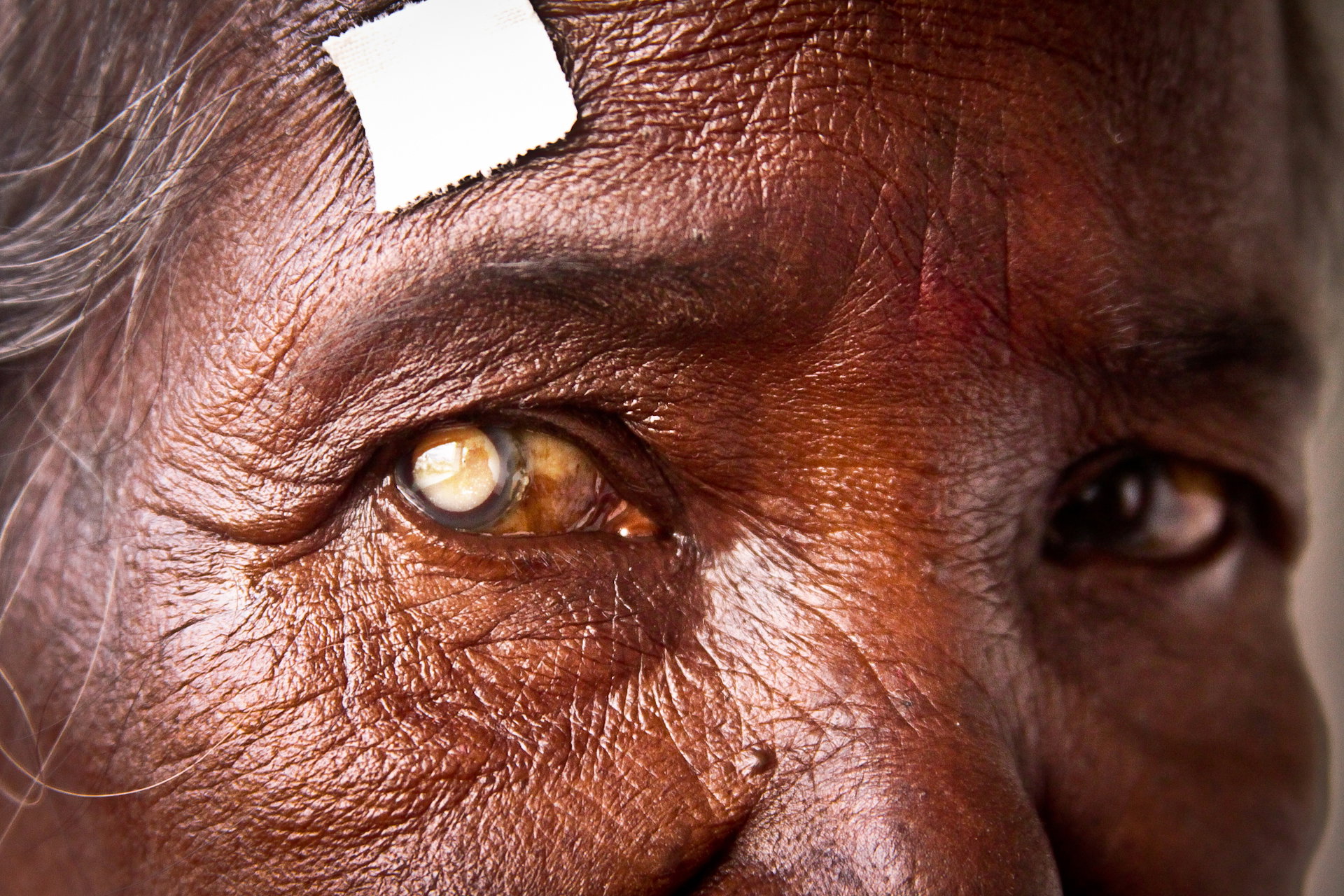 Eye camp Siliguri 2012