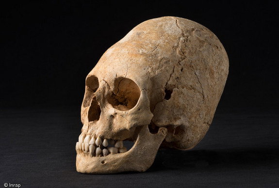 deformed-skull