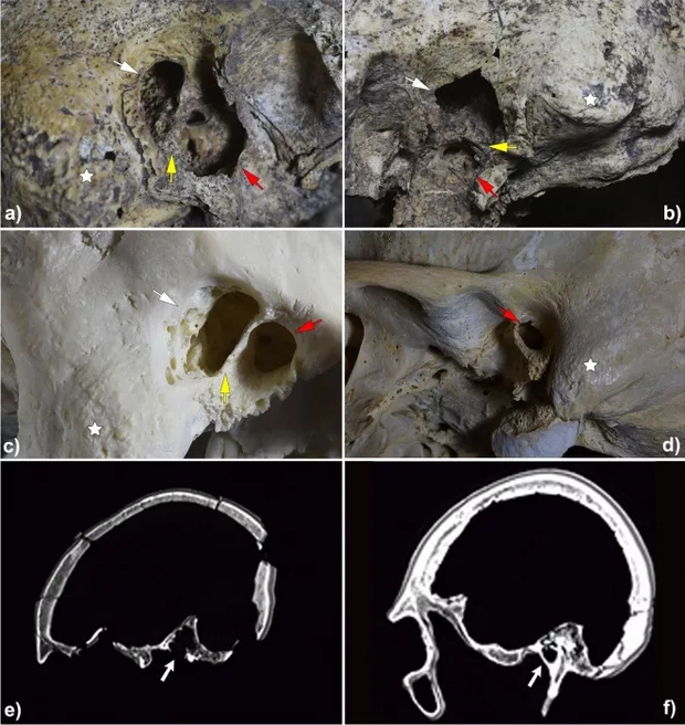 slady-zabiegu-chirurgicznego-sprzed-5300-lat-949eda1