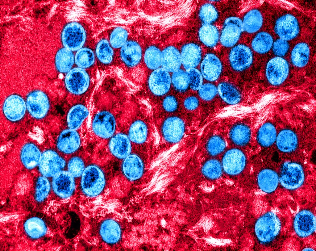 Pierwszy przypadek zakażenia wirusem powodującym mpox poza Afryką. Komu zagraża ta choroba? Jakie są objawy?