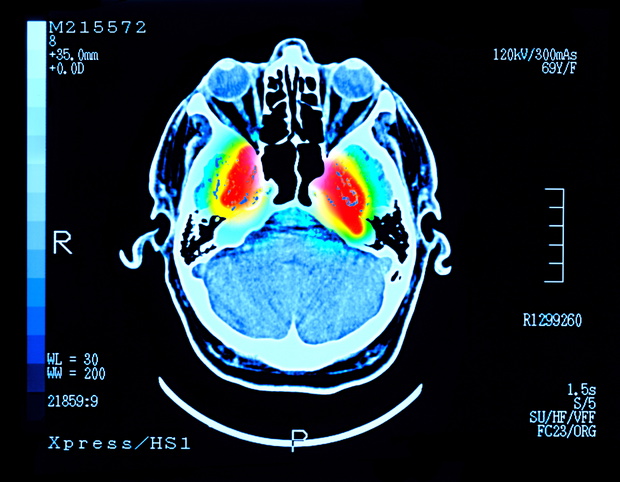 MRI Parkinson