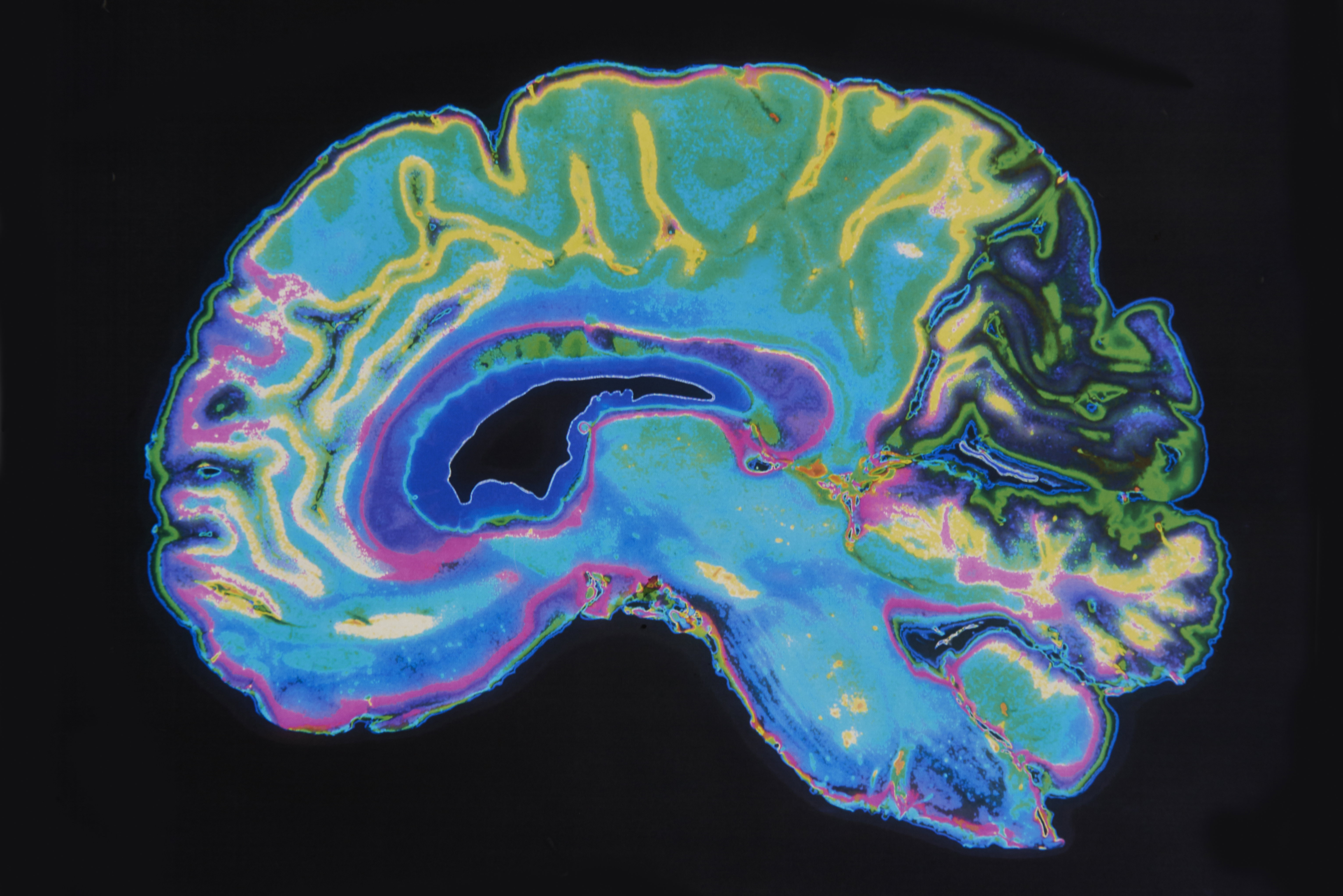 Są niepokojąco podobne. Naukowcy twierdzą, że choroba Alzheimera to tak naprawdę cukrzyca typu 3