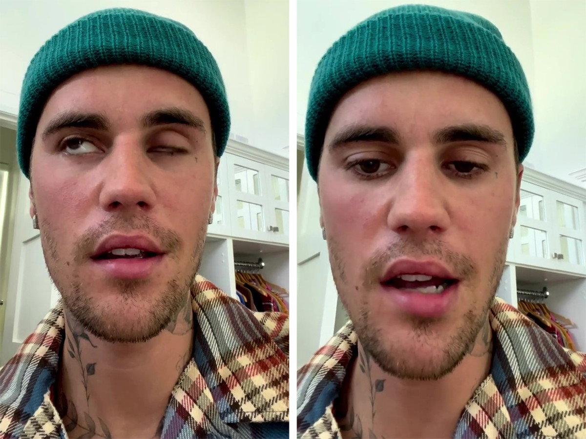 Justin Bieber ma sparaliżowaną twarz