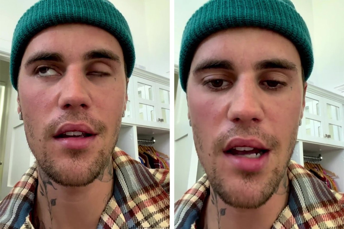 Justin Bieber ma sparaliżowaną twarz