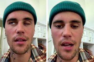 Justin Bieber ma sparaliżowaną twarz