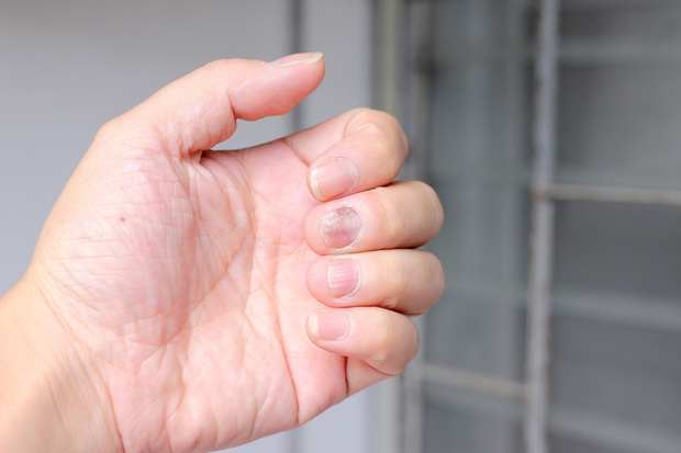 Fungus Infection on Nails Hand, Finger with onychomycosis. - soft focus