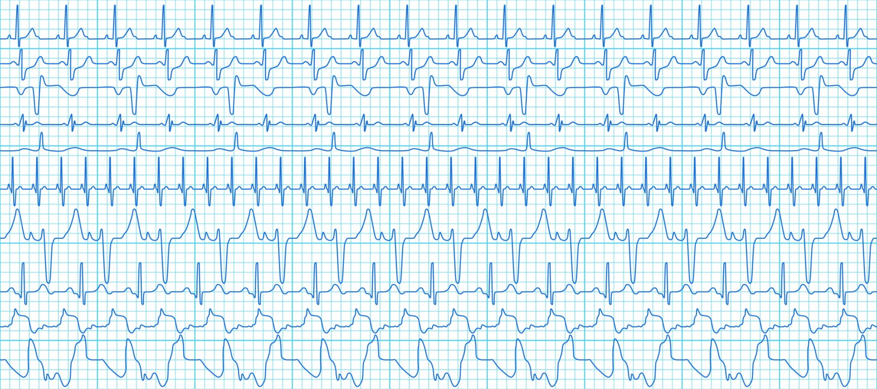 załamek EKG