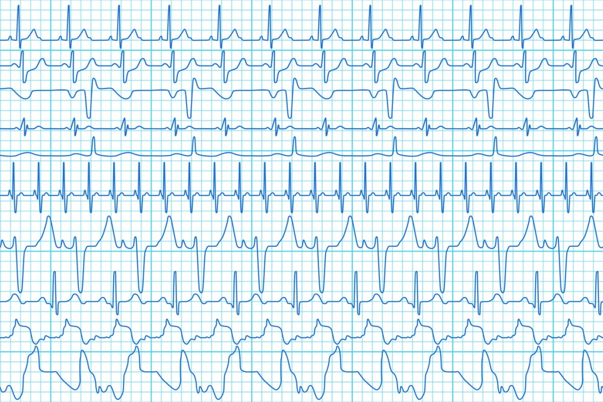 załamek EKG