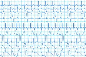 załamek EKG