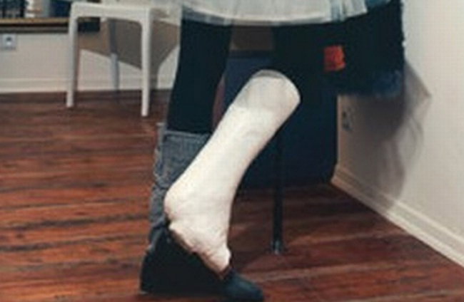 Anna Bałon pozuje w gipsie na nodze