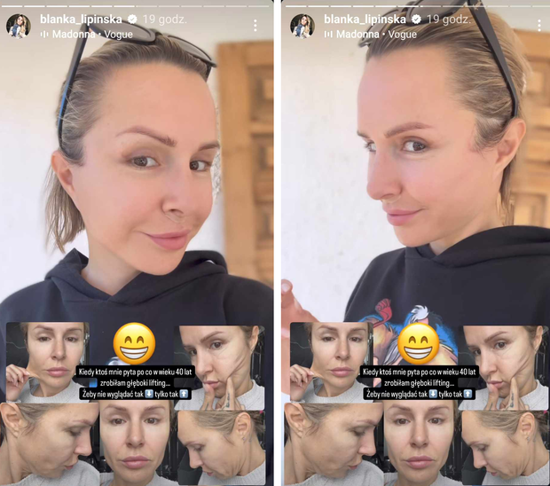 Blanka Lipińska zrobiła sobie głęboki lifting twarzy