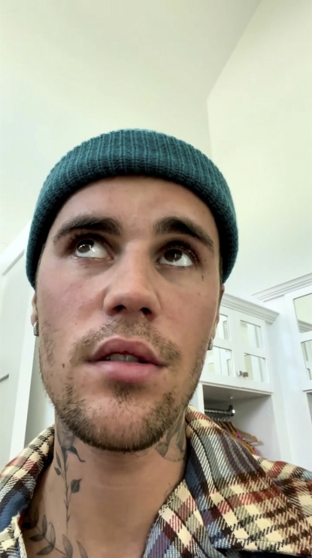 Justin Bieber ze sparali?owan? twarz?