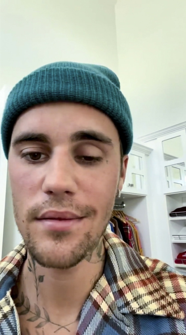 Justin Bieber ze sparali?owan? twarz?