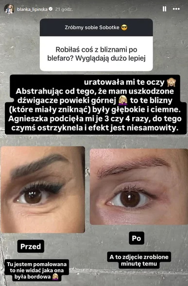 Dramatyczne wyznanie Blanki Lipińskiej o operacji powiek: "Moja doktor uratowała mi oczy"