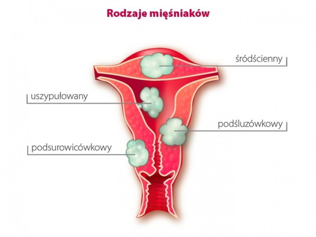 rodzaje-miesniakow-macicy-2330023-6bf2343