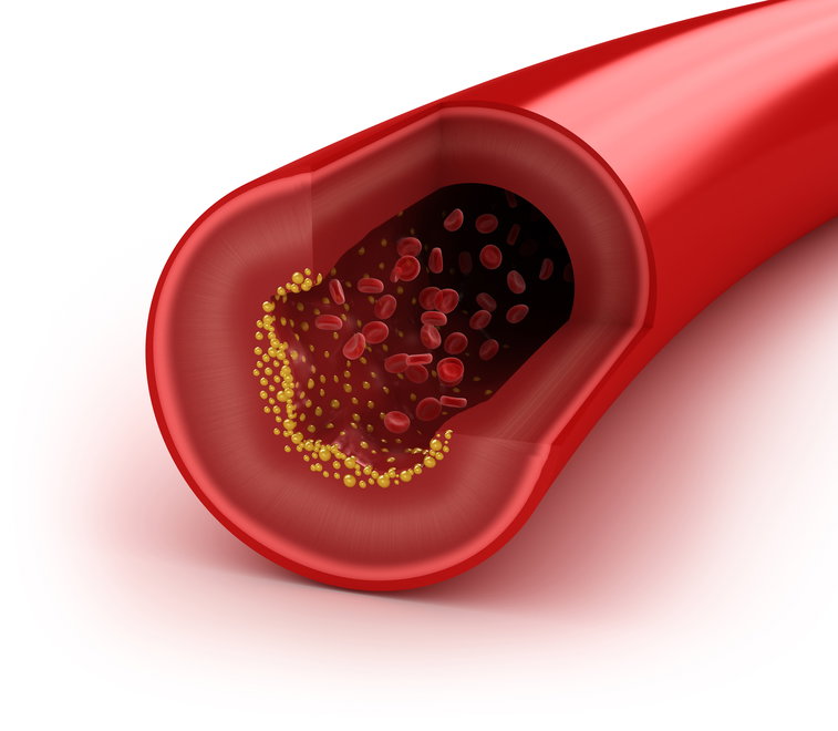 Sposoby na wysoki cholesterol