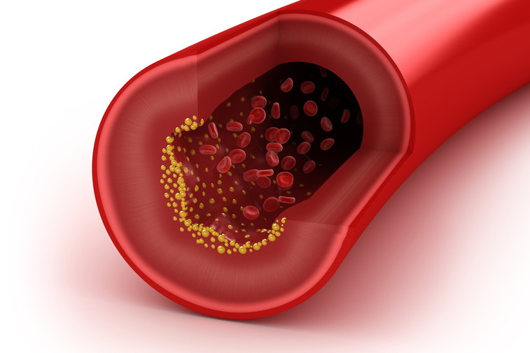 Sposoby na wysoki cholesterol