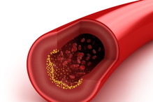 Sposoby na wysoki cholesterol