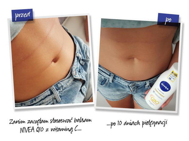 efekty-dzialania-balsamu-nivea-q10-2430023-001c1ab