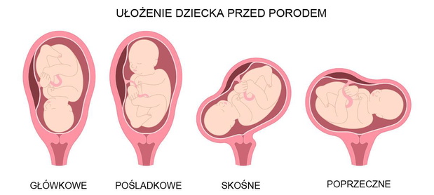 ulozenie-dziecka-do-porodu-jpg-2504883-df623ff