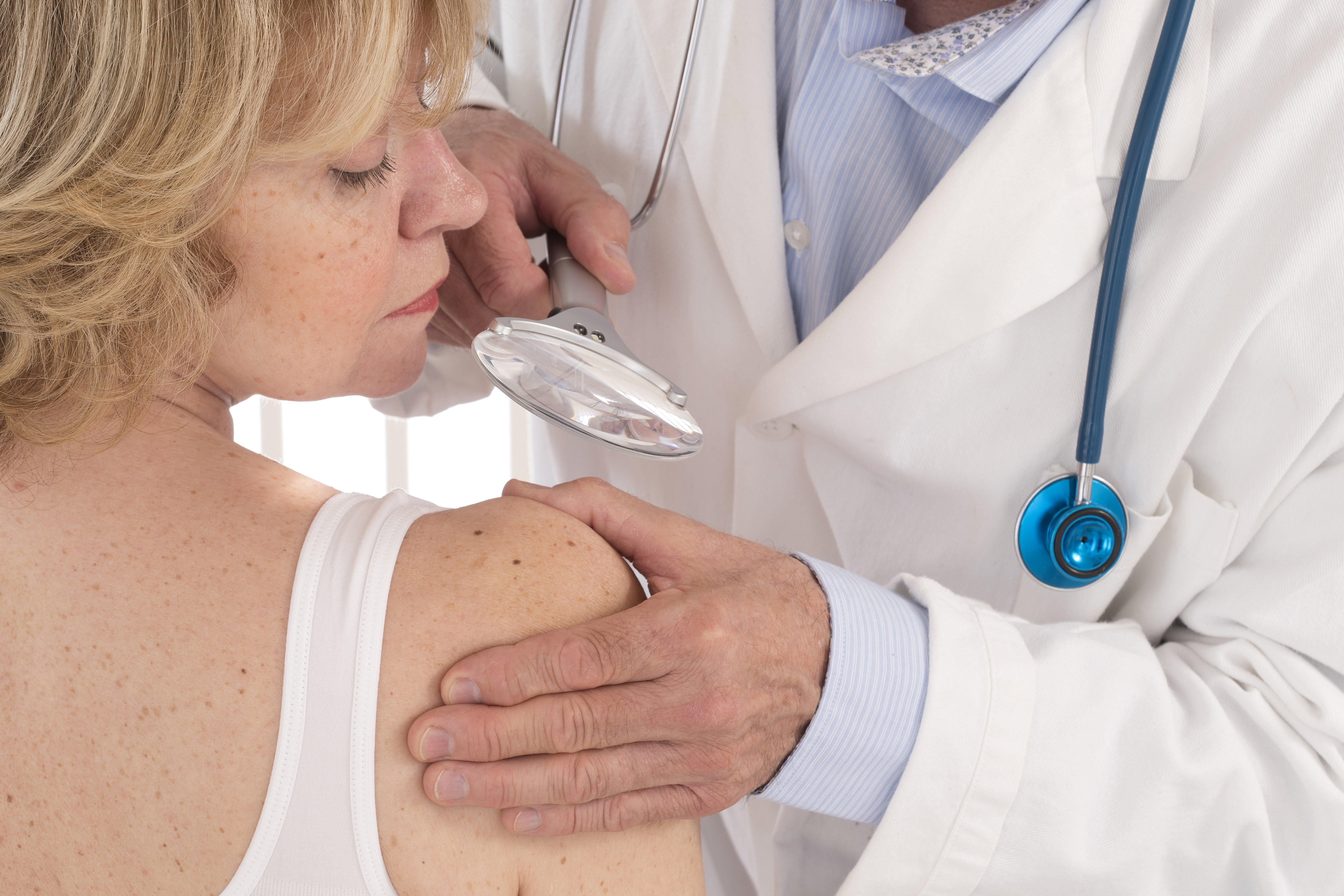 Znamiona i pieprzyki po opalaniu - diagnostyka i usuwanie