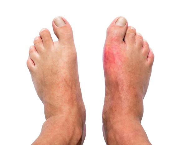 dna-moczanowa-staw-2455901-15c6b21