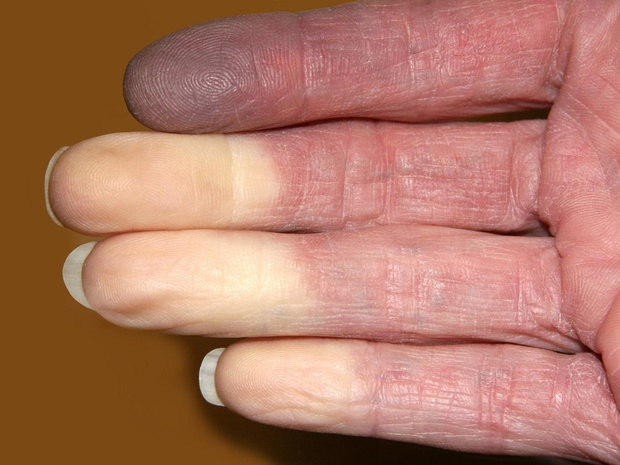choroba-raynauda-objawy-2489169-d0046ad