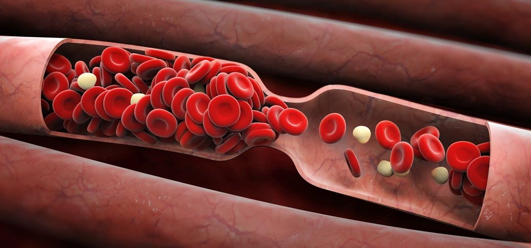 wysoki cholesterol