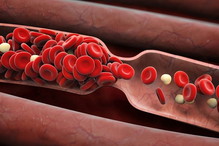 wysoki cholesterol