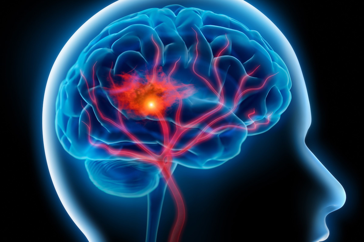 udar mozgu