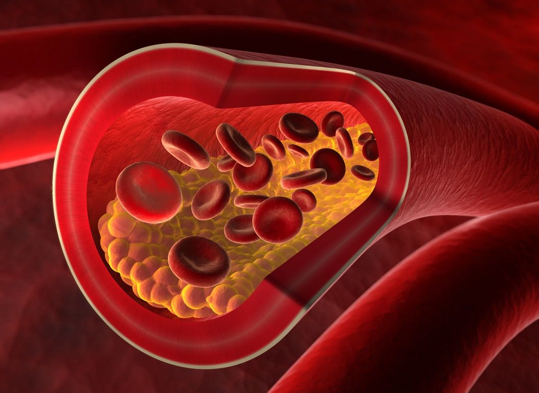 Hipercholesterolemia