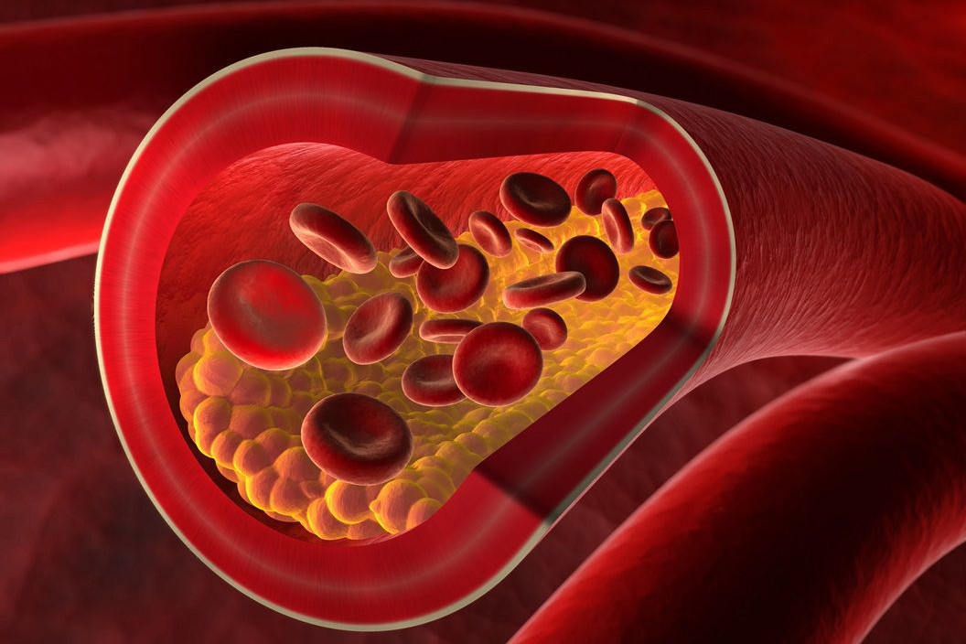 Hipercholesterolemia