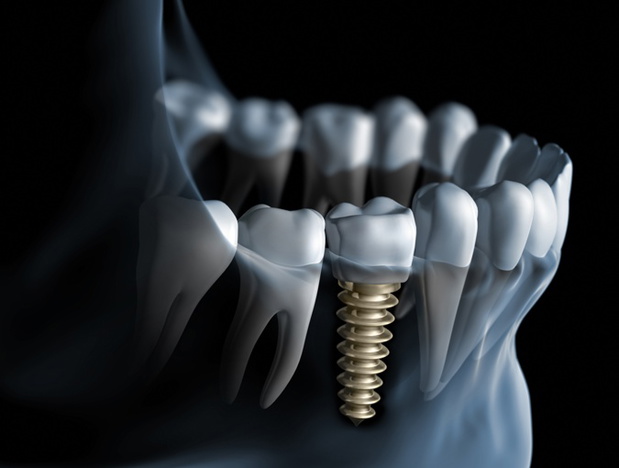 implant-4dbfa5e