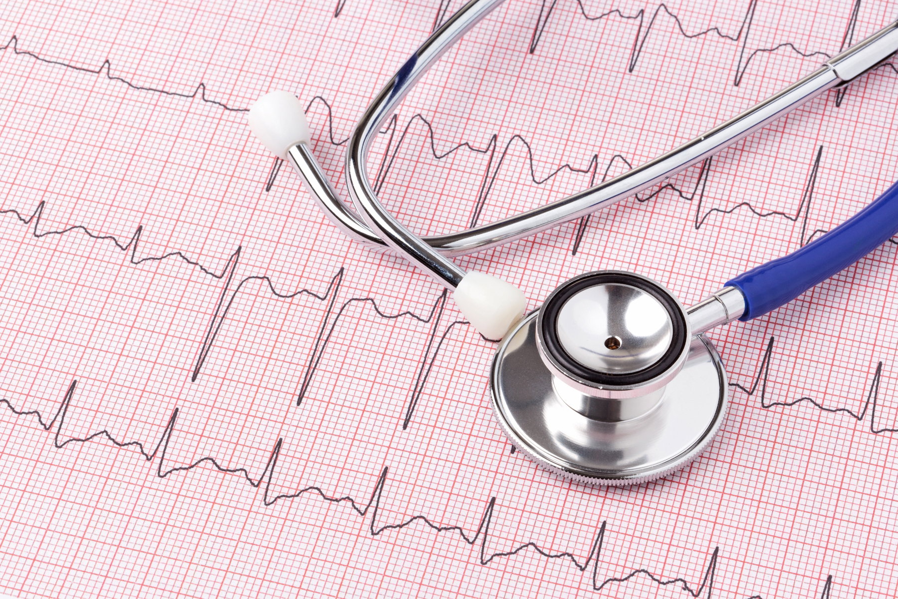 EKG