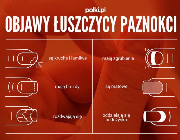 luszczyca-paznokci-2440469-845b106