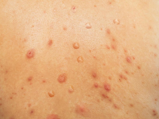 malpia-ospa-jak-wyglada-wysypka-2484461-a0154d2