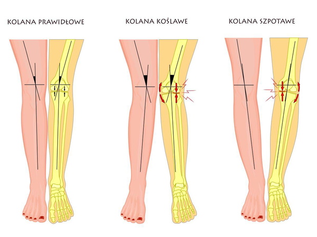kolana-szpotawe-kolana-koslawe-2456920-b984f8f