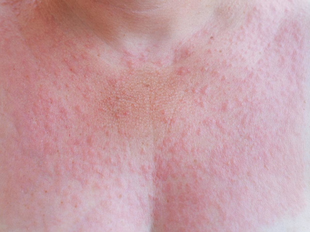 wysypka-po-opalaniu-alergia-2516092-16272d1
