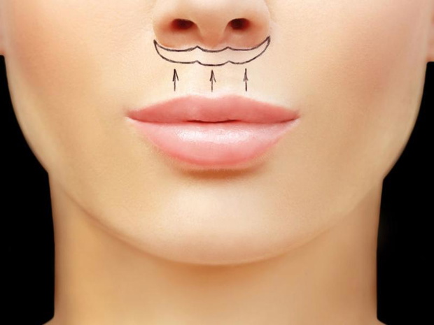 na-czym-polega-lip-lift-2517514-22aad63
