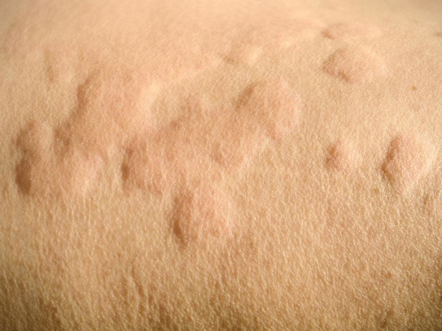 okragle-plamy-na-skorze-pokrzywka-alergiczna-2502817-0d8ec4e