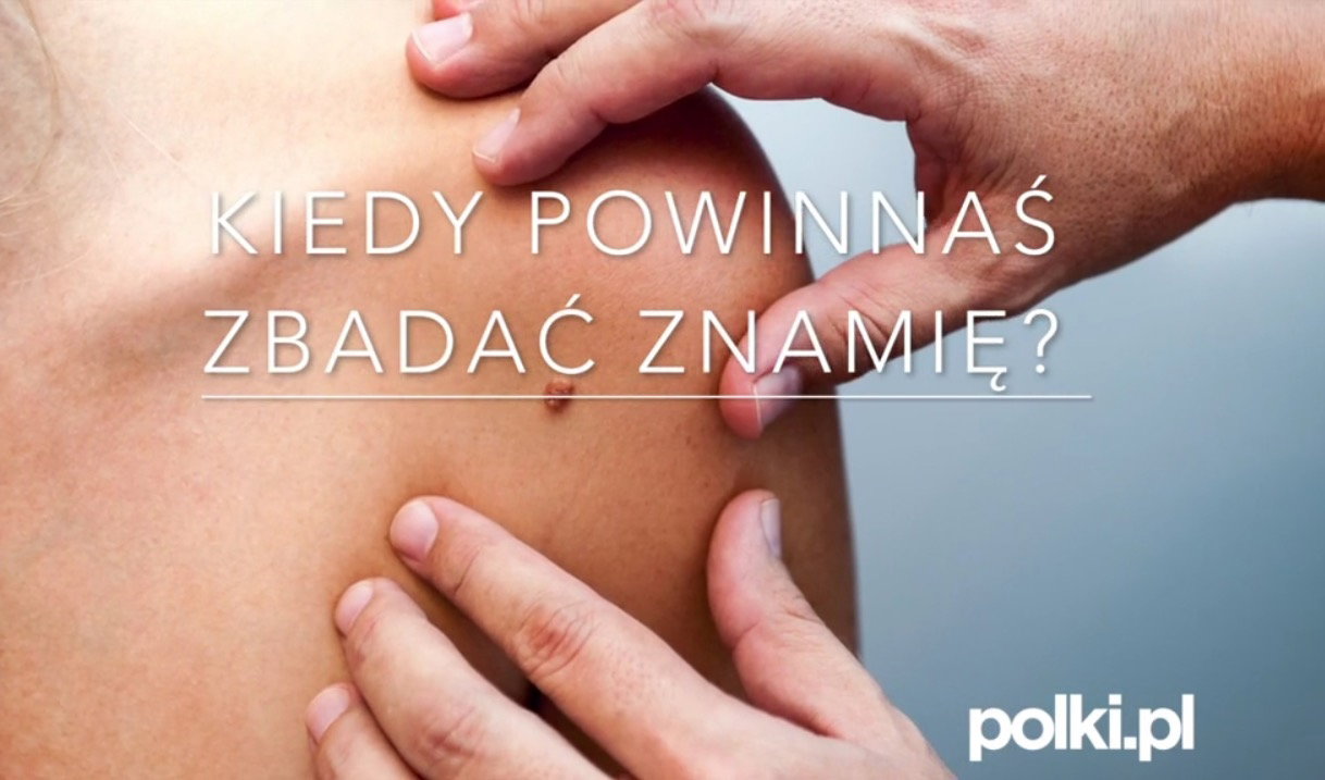 Kiedy zbadać znamię - 5 ważnych objawów czerniaka
