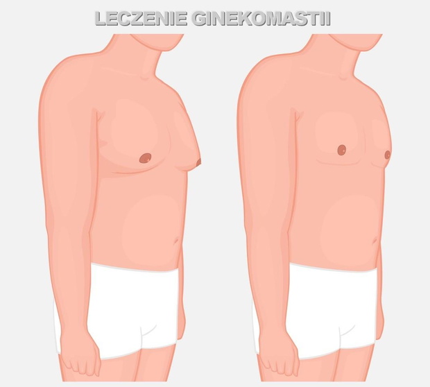 leczenie-ginekomastii-2433451-ed473df