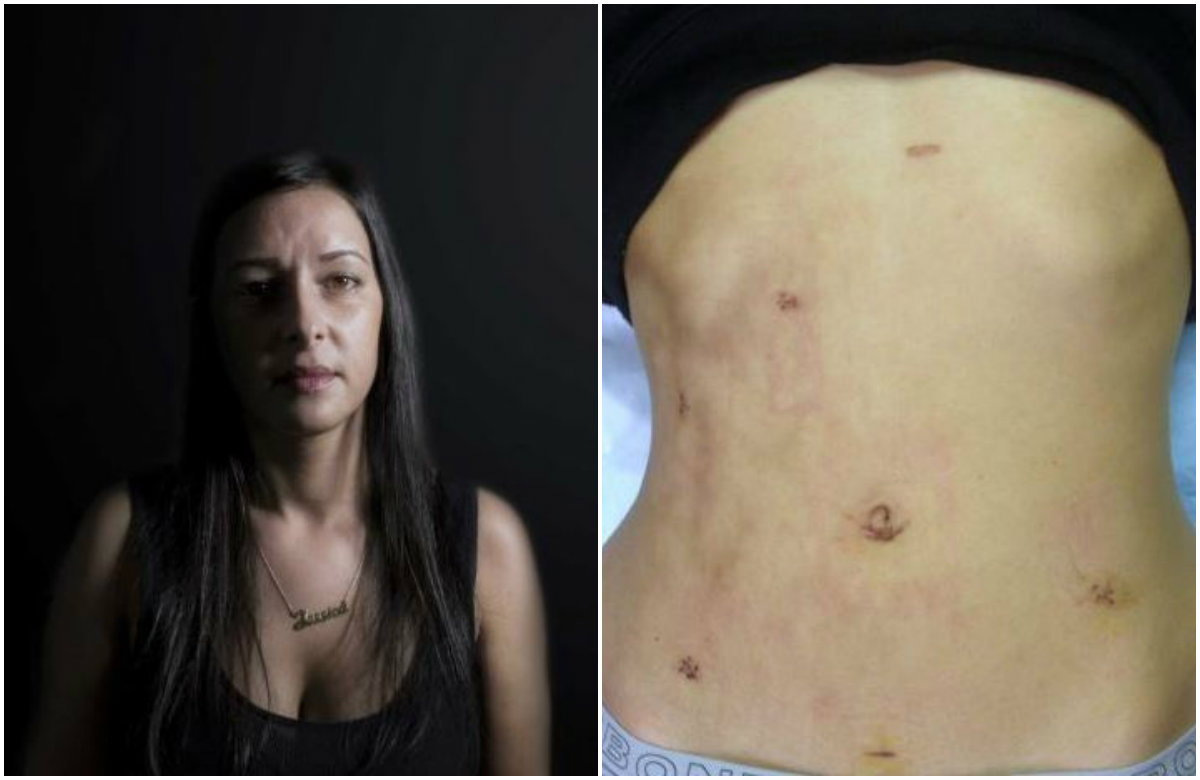 endometrioza