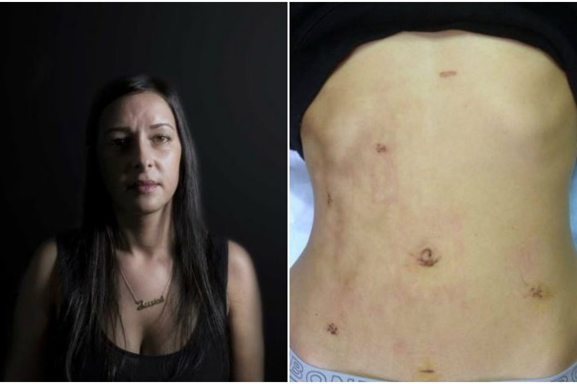 endometrioza