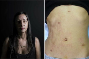 endometrioza