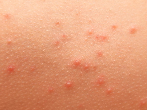wysypka-alergiczna-zdjecia-2493132-0fb3c1b