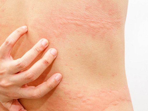 wysypka-alergiczna-pokrzywka-2493134-42c1629