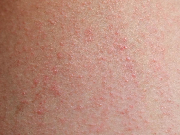 wysypka-alergiczna-grudki-2493135-e9ddd16